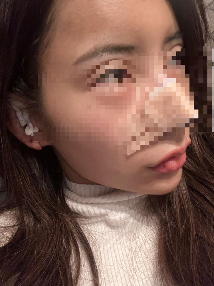 鼻整形２日目は◯◯◯