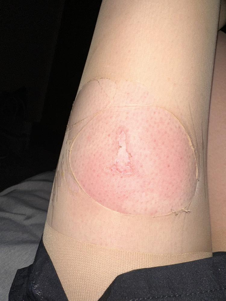 火傷しました💦