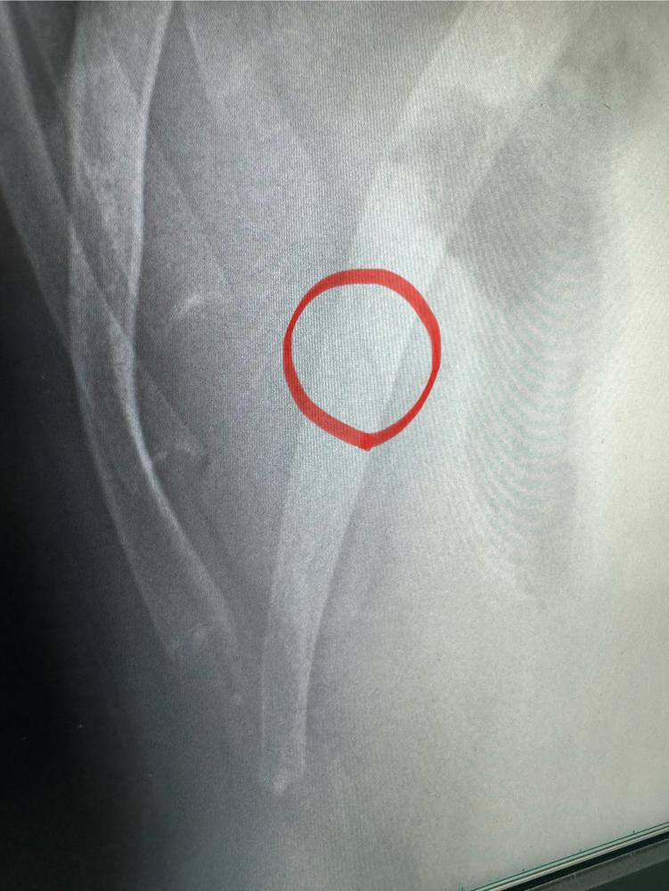 肋骨にヒビが入りましたが