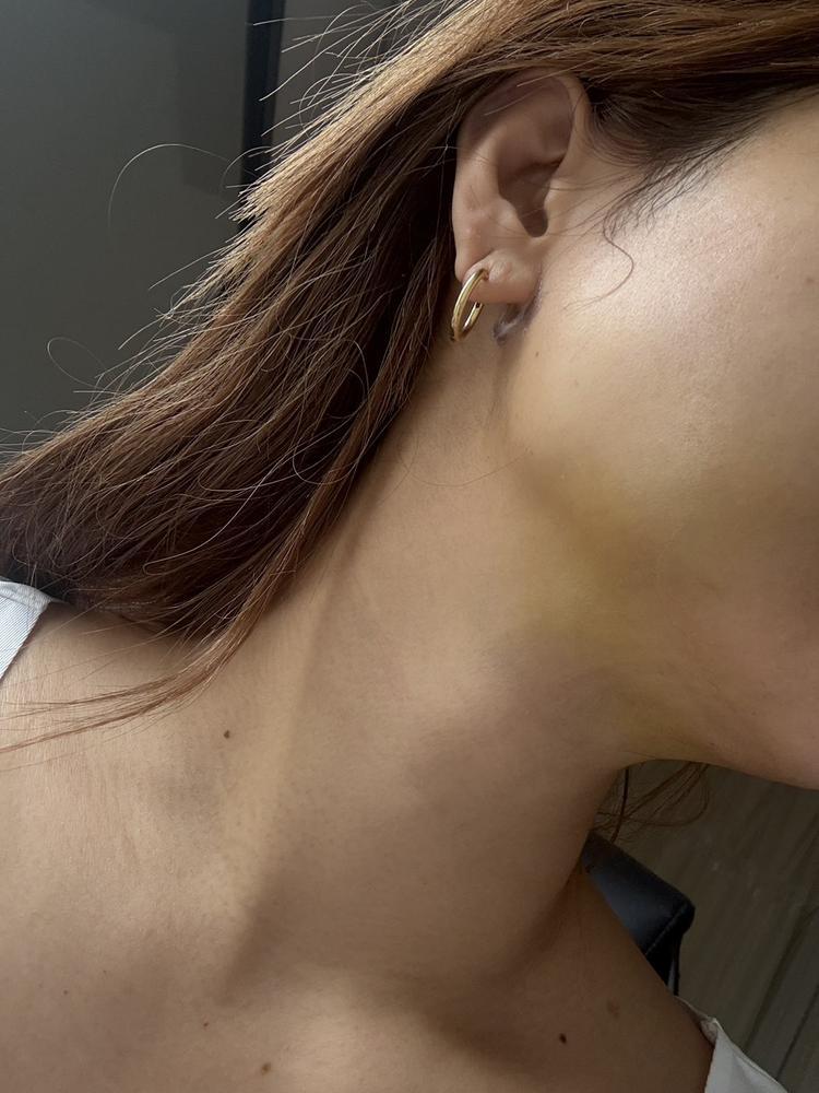 脂肪吸引腫れませんは嘘っぱち